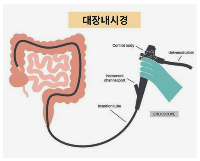 대장내시경 후 우버 이용 불가 이유 1 대장내시경